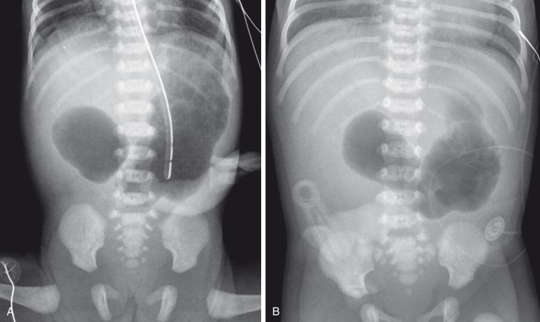 Figure 102.3, Duodenal atresia.