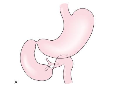 Figure 102.4, Duodenal atresia with anomalous ducts.