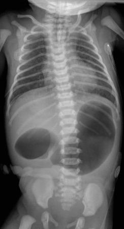 e-Figure 102.5, Duodenal and esophageal atresia.