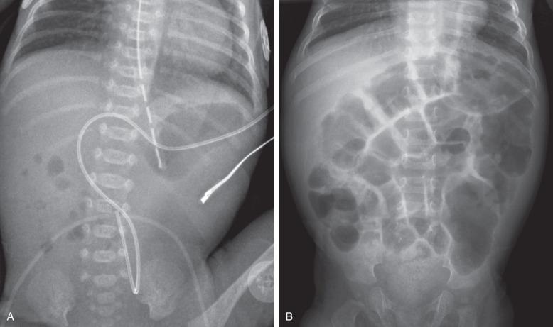 e-Figure 102.6, Duodenal stenosis.