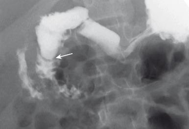 Figure 102.7, Duodenal web and malrotation UGI in adolescent with history of intermittent abdominal pain shows a duodenal web (arrow) . Note that duodenal contrast does not cross to the left of midline, indicating malrotation.