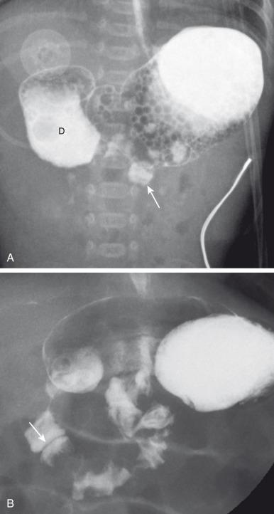 Figure 102.8, Duodenal stenosis.