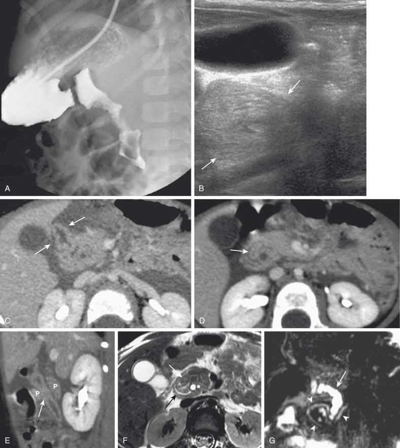 Figure 102.9, Annular pancreas.