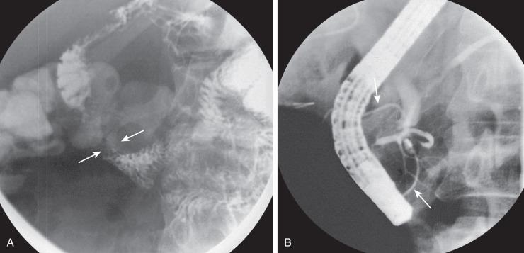 e-Figure 102.10, Annular pancreas.