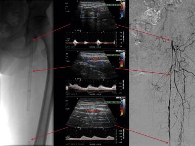 FIGURE 1, Arterial duplex mapping with corresponding angiographic images of multiple in-stent stenoses of the left superficial femoral artery (SFA) in a patient with a left foot ulceration. Ultrasound was also able to identify an occlusion in the proximal (CFA), with retrograde flow in the profunda femoris artery (PFA).