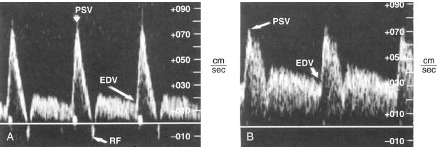 FIGURE 2, A and B, Fasting superior mesenteric (A) and celiac artery (B) waveforms. Peak systolic velocities (PSV) tend to be higher in the superior mesenteric artery compared to the celiac artery, and end-diastolic velocities (EDV) tend to be higher in the celiac artery compared to the superior mesenteric artery. There is often a reverse flow (RF) component at end-systole in the superior mesenteric artery waveform. The lower EDV and the end-systolic reverse flow component of the superior mesenteric artery reflect more resistive flow in the fasting superior mesenteric artery.