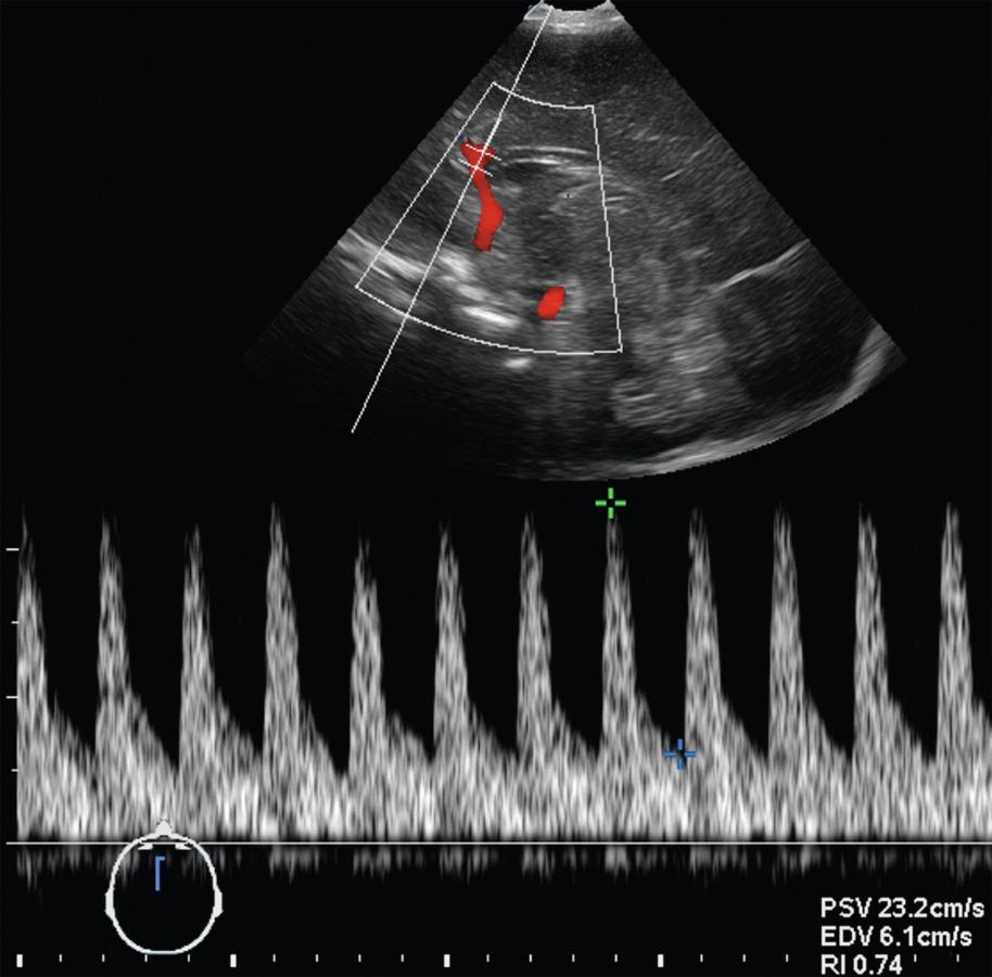 FIG. 46.2, Determination of Peak Systolic Flow Velocity (PSV), End-Diastolic Flow Velocity (EDV) and Resistive Index (RI) Within an Arterial Branch of the Anterior Arterial Circulation.