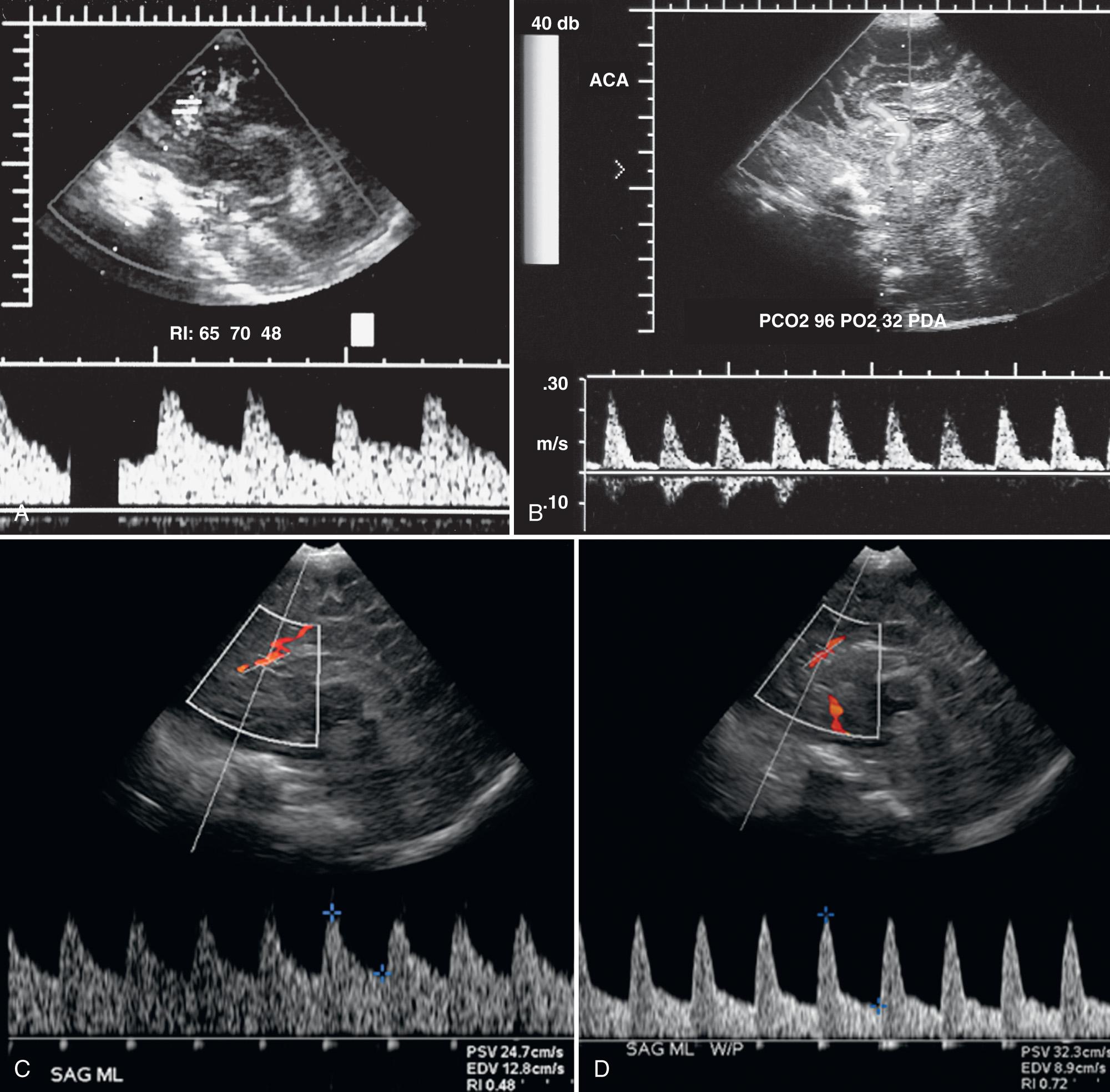 FIG. 46.3, Factors Affecting Intracranial Resistive Index (RI).