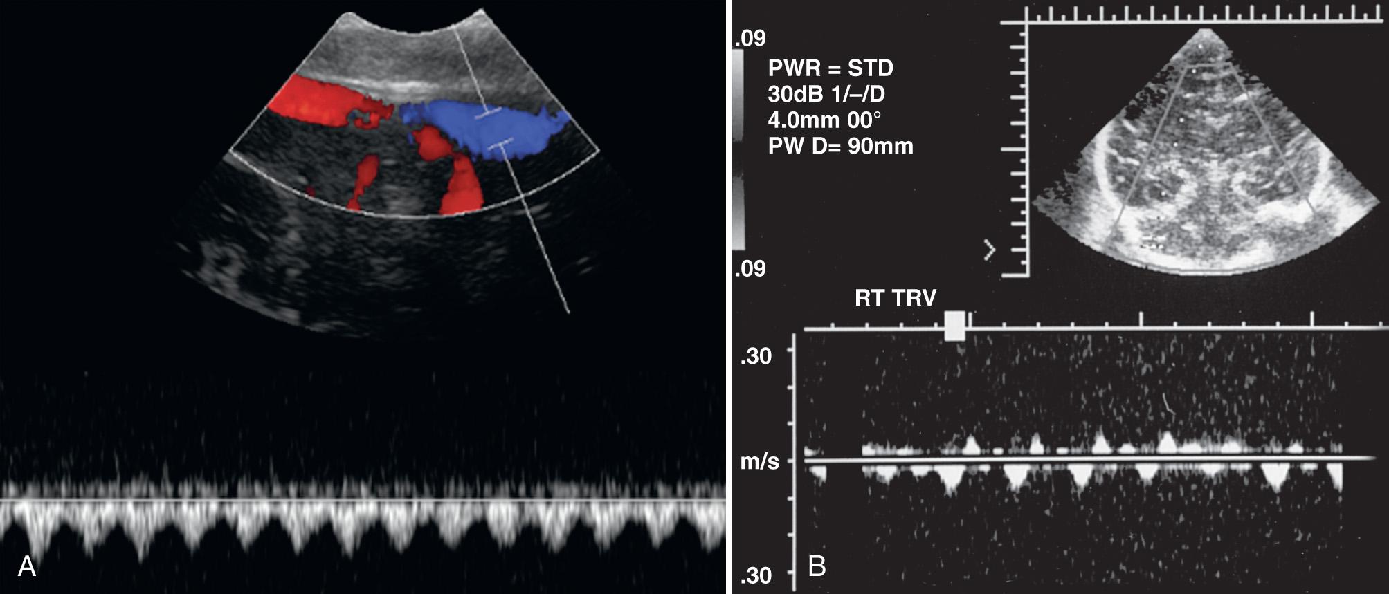 FIG. 46.4, Referred Cardiac Pulsations in Veins.