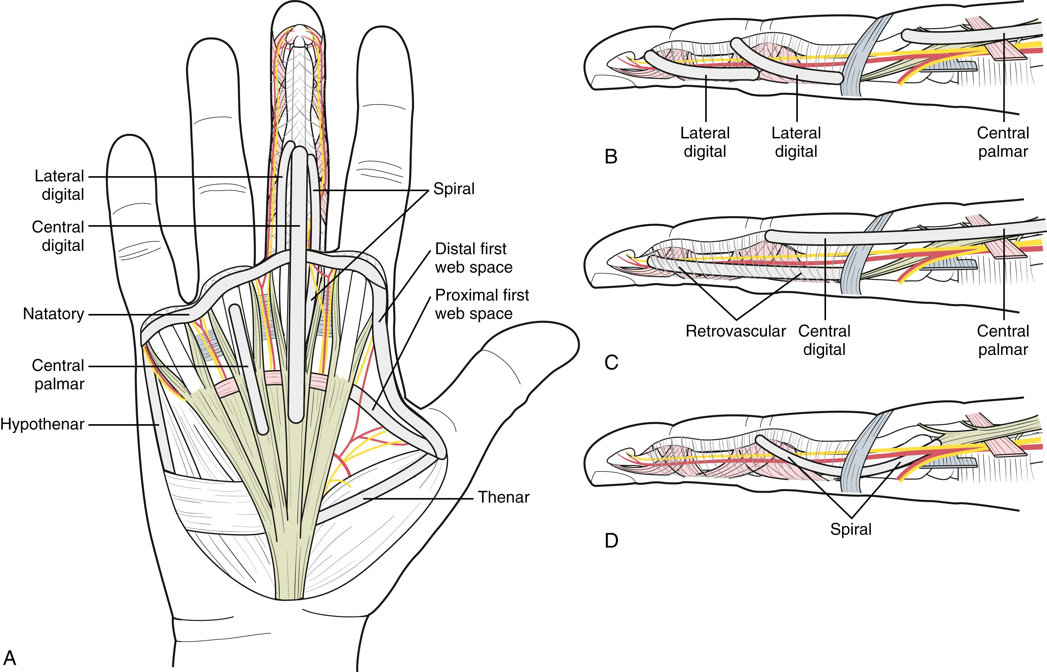 Fig. 4.11, Common cord patterns. A, Central digital, central palmar, distal first web space, hypothenar, (B) lateral digital, (C) retrovascular, (D) spiral.