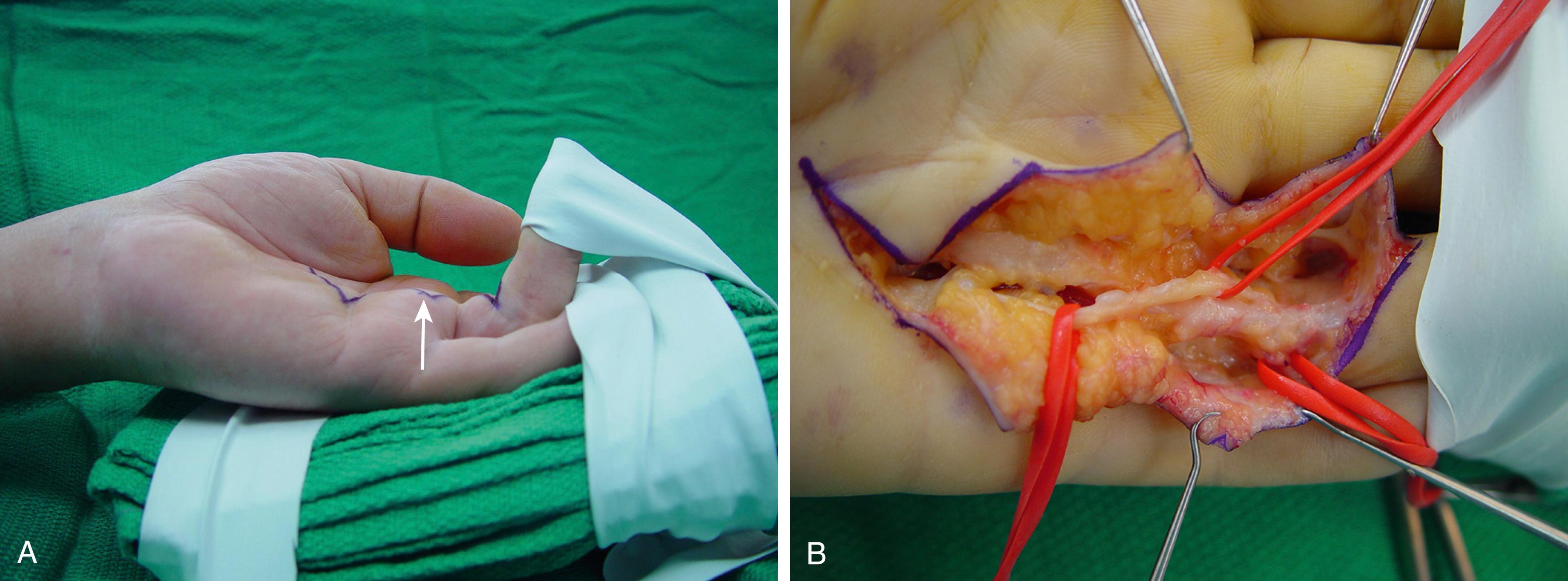 Fig. 4.13, Spiral neurovascular bundles may be associated with a local fleshy prominence superficial to a cord. A, Arrow points to a palmar prominence superficial to a ring finger cord between the distal palmar crease and proximal finger flexion crease. This is a common location. B, Vessel loops around this spiral ulnar neurovascular bundle passing superficial to the cord at the site of soft tissue prominence.