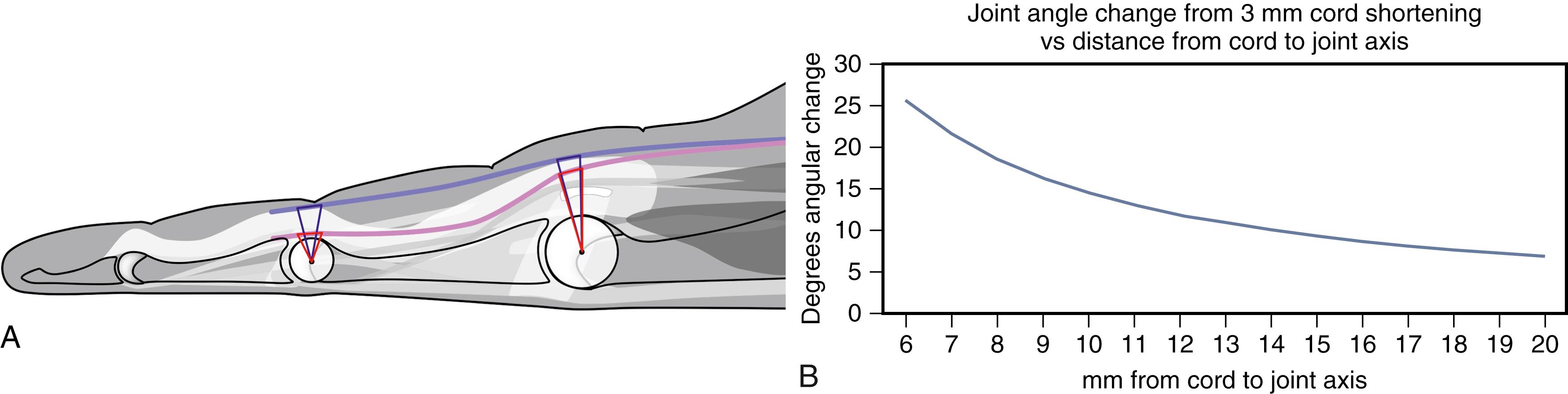 Fig. 4.2, A joint’s angular change from a given cord length change depends on the cord’s distance from the joint’s rotation axis. A, In this visual example, the same linear change results in a 13-degree angular change from a central MCP cord, 17 degrees from a lateral MCP cord, 25 degrees from a central PIP cord, and 45 degrees from a lateral PIP cord. B, This graph shows calculated angle changes from 3 mm of cord shortening at different distances from a joint’s axis. The angular change increases logarithmically as cord-axis distance decreases. It might seem unintuitive compared with the effects of flexor tendon bowstringing, but the same geometry applies.