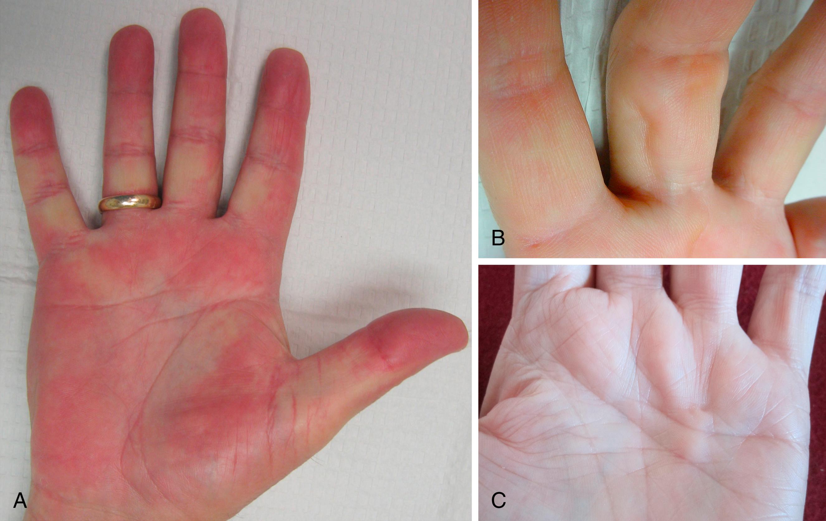 Fig. 4.3, Earliest signs of Dupuytren disease in patients with DC on the opposite hand. A, palmar skin tightness, blanching in the digits with neutral extension. B, Dimpling of the lateral digit. C, Prominence of the interdigital palmar monticuli in the distal palm from central band tightness. This hand also demonstrates a ring finger nodule with adjacent distal skin retraction.