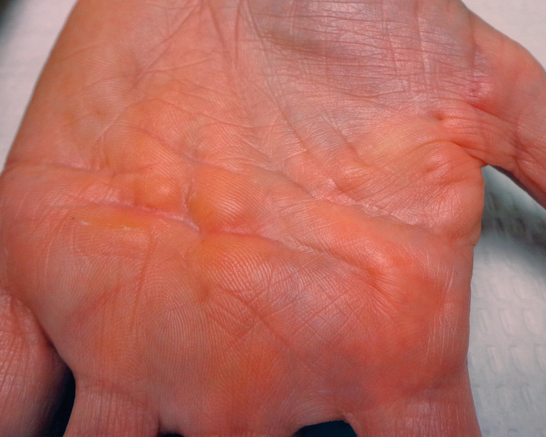 Fig. 4.4, This patient has diffuse nodular skin involvement of DD but no contractures. The dermal papillae are abnormally prominent over the middle and ring rays’ nodules, almost resembling fingerprints. Dimples and nodules are also visible at the base of the index and thumb and the first web space.