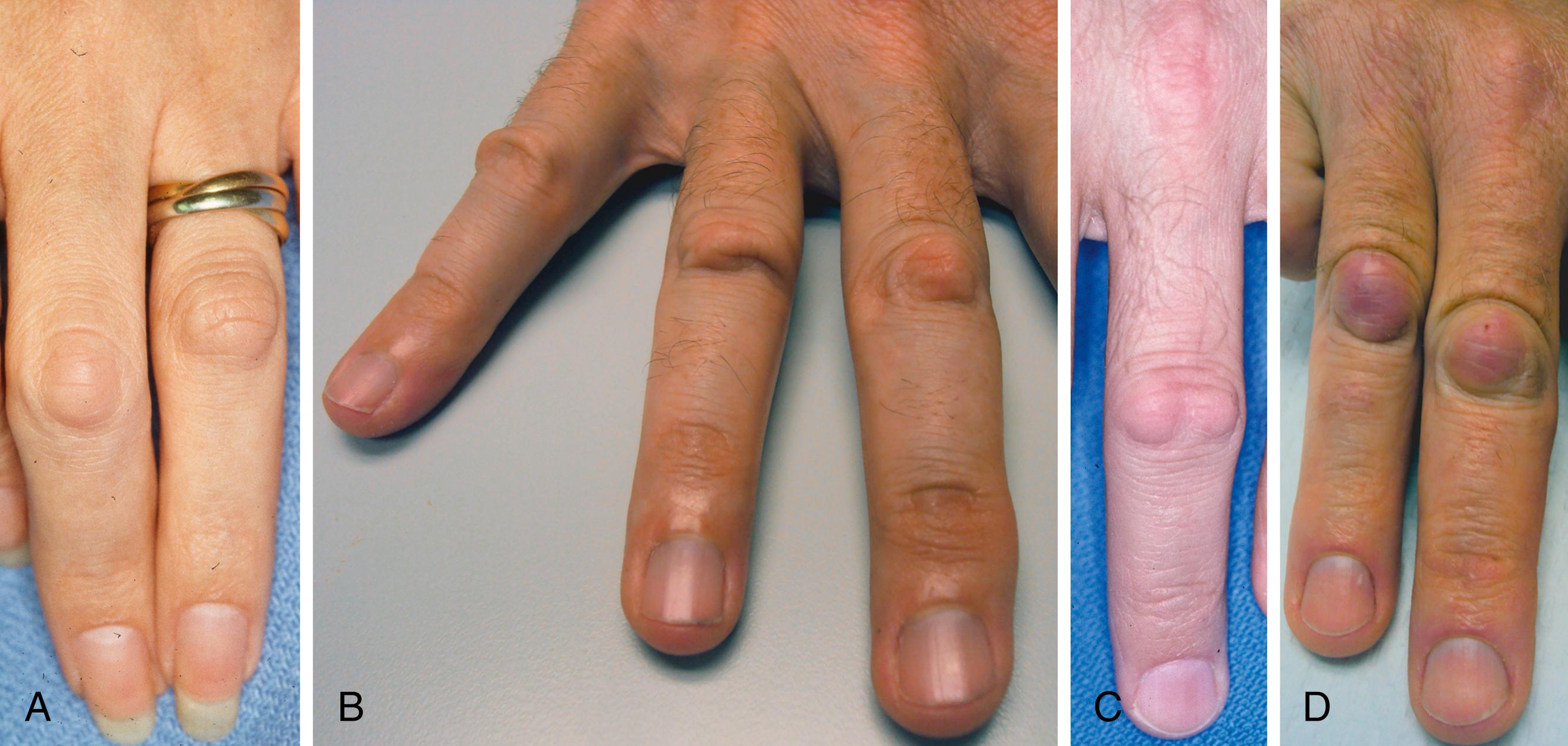 Fig. 4.5, Variations of dorsal Dupuytren nodules. A, No skin involvement. B, Dimpling with or without nodule. C, Prominence over the condyles. D, Inflammatory with diffuse skin tethering.