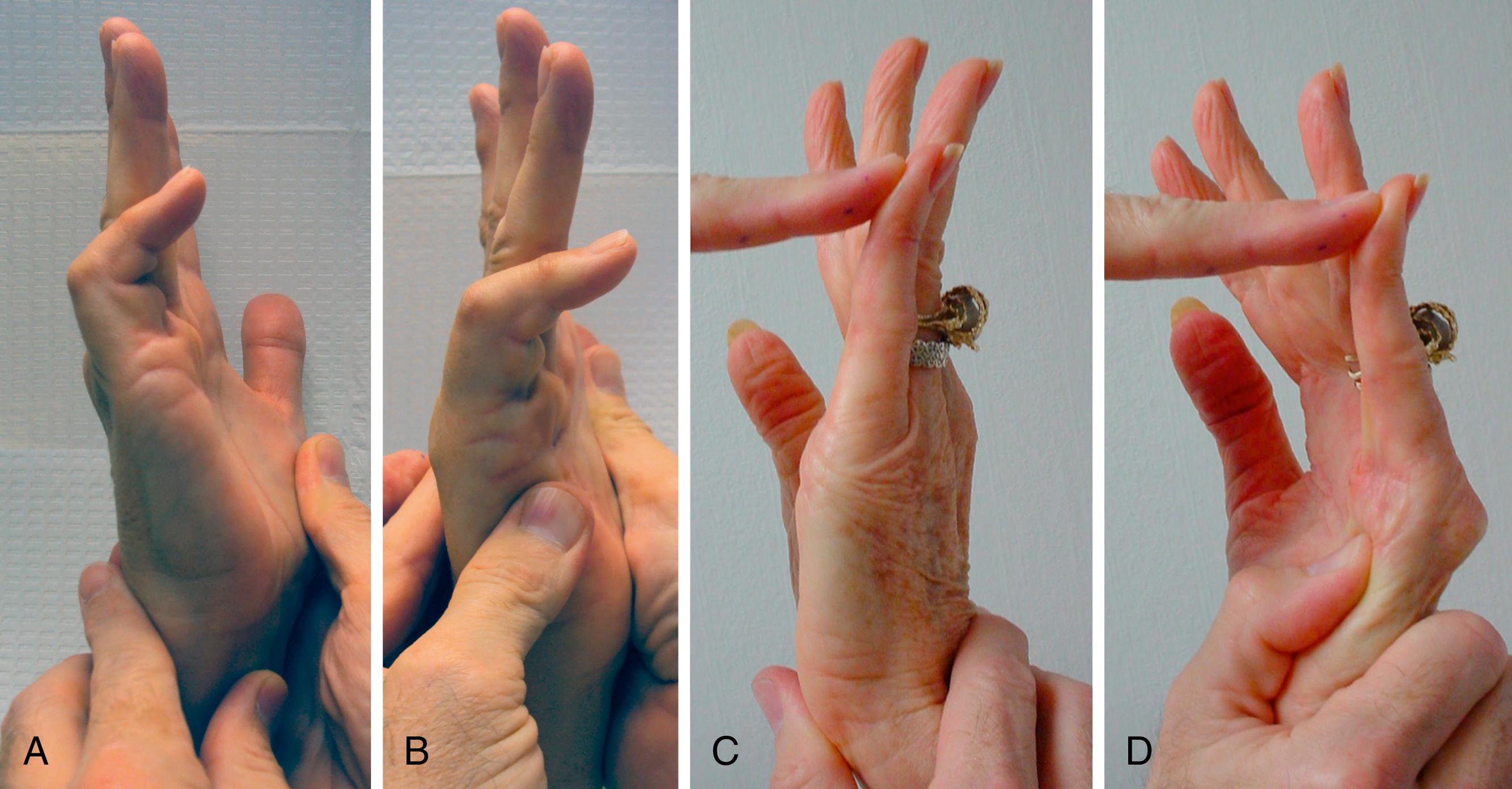 Fig. 4.6, Demonstration of dynamic contractures with CMC fasciodesis. A, Patients use a trick motion to compensate for tight fascia, flexing their ring and small CMC joints to allow MCP extension. B, CMC flexion allows 10 degrees of active MCP hyperextension. C, When CMC flexion is blocked, active MCP extension is limited to 20 degrees, which improves active PIP extension by 10 degrees. D, Blocking CMC flexion changes passive MCP extension from 0 to 65 degrees.