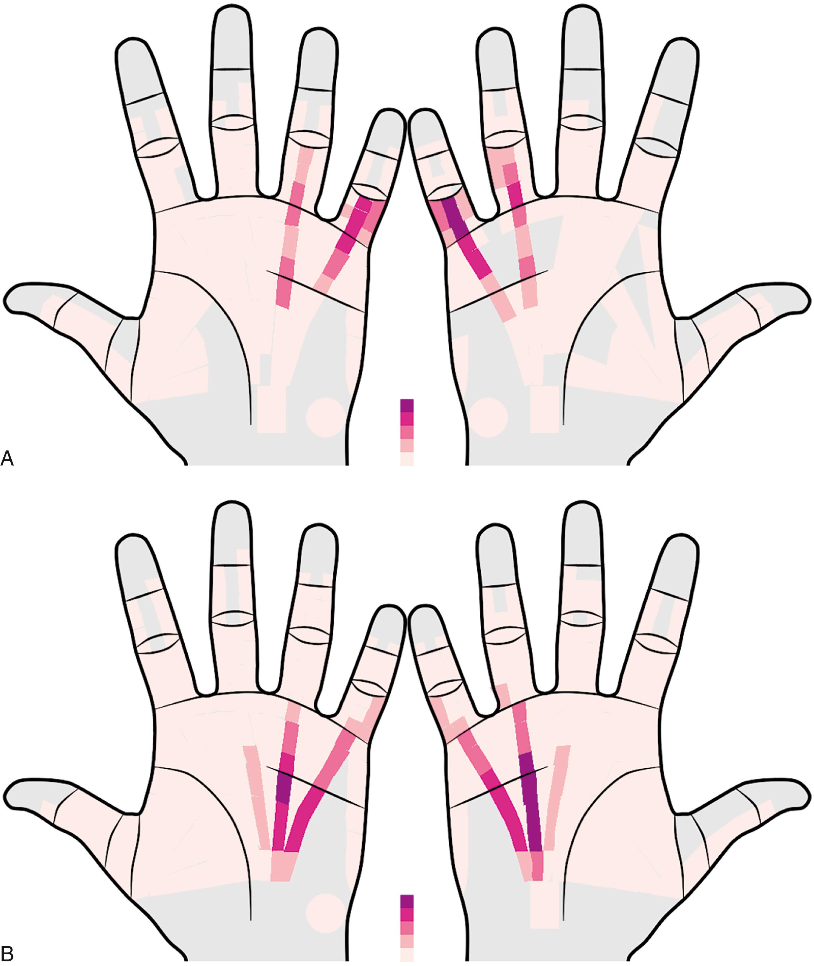 Fig. 4.9, Prevalence heat maps of all cord and nodule locations in the hands of 2046 Dupuytren patients with no prior treatment, author’s series using the diagram in Fig. 4.7 . Each color represents an incidence quintile, with the darkest color representing the top 20% most common locations, the next dark the next most quintile, and so on. A, 4181 nodule locations. The most common nodule locations are not in areas of defined fascia but in grip-related mechanical stress zones. B, 34640 cord locations. The most common cord locations correspond somewhat with fascia anatomy and areas where tissues are slack at rest. Individual locations did not correlate with medical disorders, diathesis factors, or duration of disease.