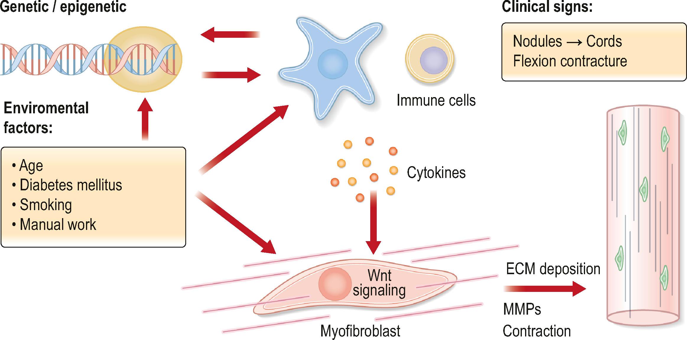 Figure 17.1, The pathogenesis of Dupuytren’s disease involving the interplay between genetic, epigenetic, immunologic, and environmental factors.