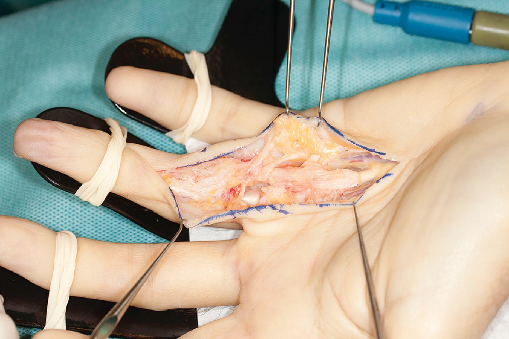 Figure 17.11, Classic spiral cord formed by pretendinous (PT) cord (released proximally), layer 2 of PT beyond transverse ligament of the palmar aponeurosis (left intact), the actual spiral cord, which lifts and displaces the ulnar neurovascular bundle just proximal of the natatory ligament (still intact) and is continuous with the lateral digital sheet, Grayson’s trabecular network cord (forming a central cord in the proximal phalanx, ending at the A4 pulley (not shown).