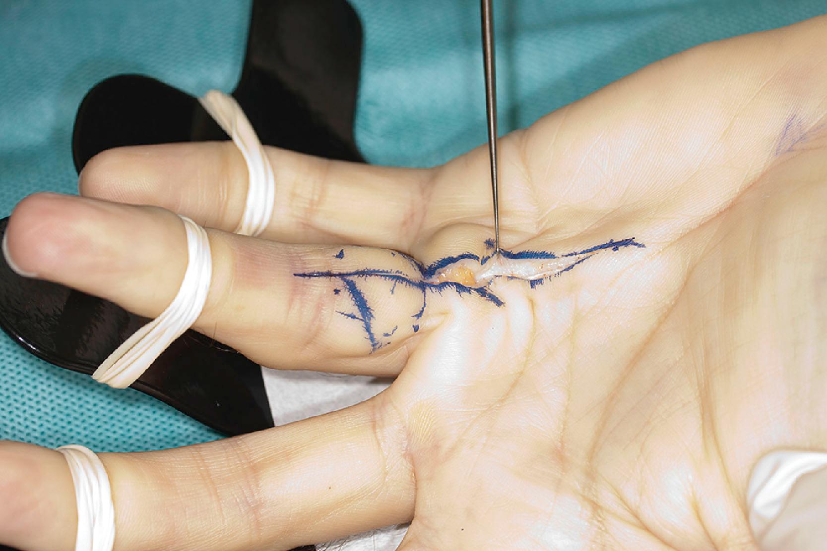 Figure 17.12, Longitudinal incision at the start of limited fasciectomy exposing a pretendinous cord that is covered by fat in the distal palm: a warning sign for a spiral nerve, as exposed in Fig. 17.11 .