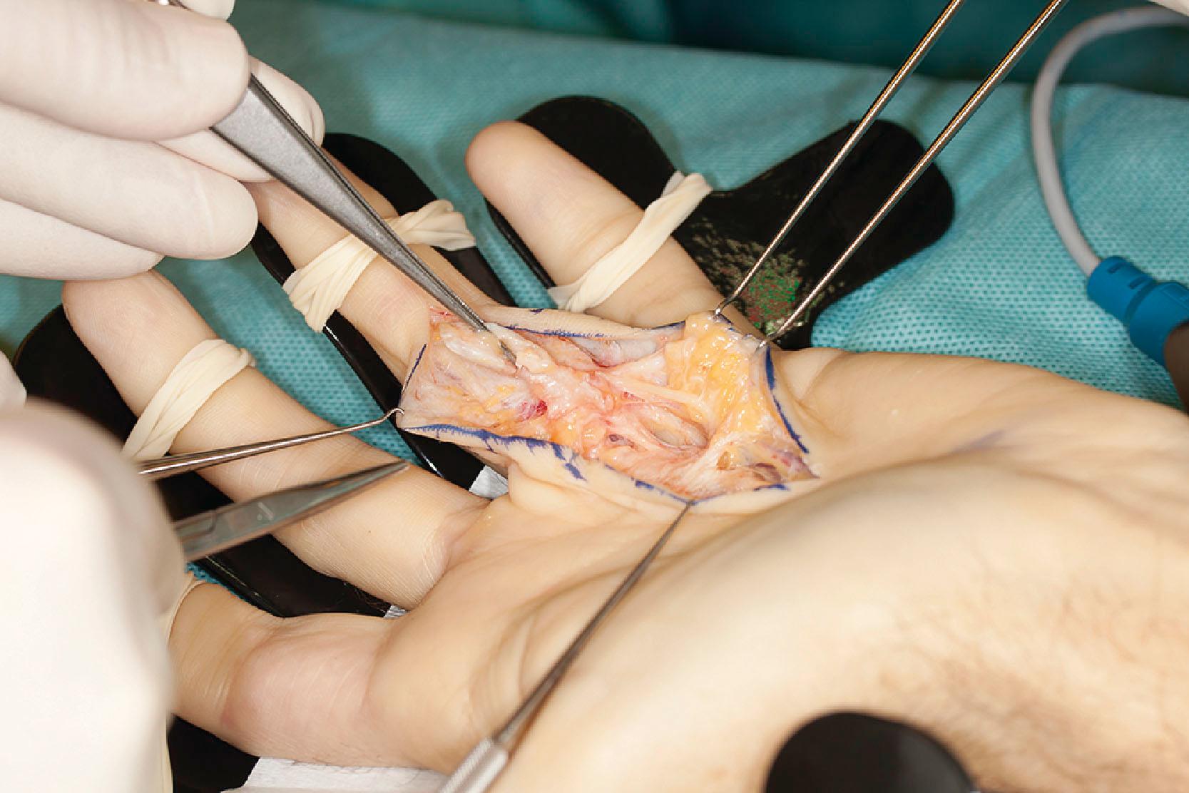 Figure 17.13, Same case as Figs. 17.11 & 17.12 . A pretendinous (PT) cord has been released proximally and is reflected distally and held by a forceps. The transverse ligament of the palmar aponeurosis (TLPA) is left intact. The ulnar neurovascular bundle can be seen to appear from under TLPA and seems to run over the natatory ligament, which is not the case. It actually takes a sharp bend at the point of reflection of PT. Deep in the distal palm a cord can be seen that originates from the interosseous muscles and blends with the reflected layer 2. These two together form the proximal part of the palmodigital spiraling system.