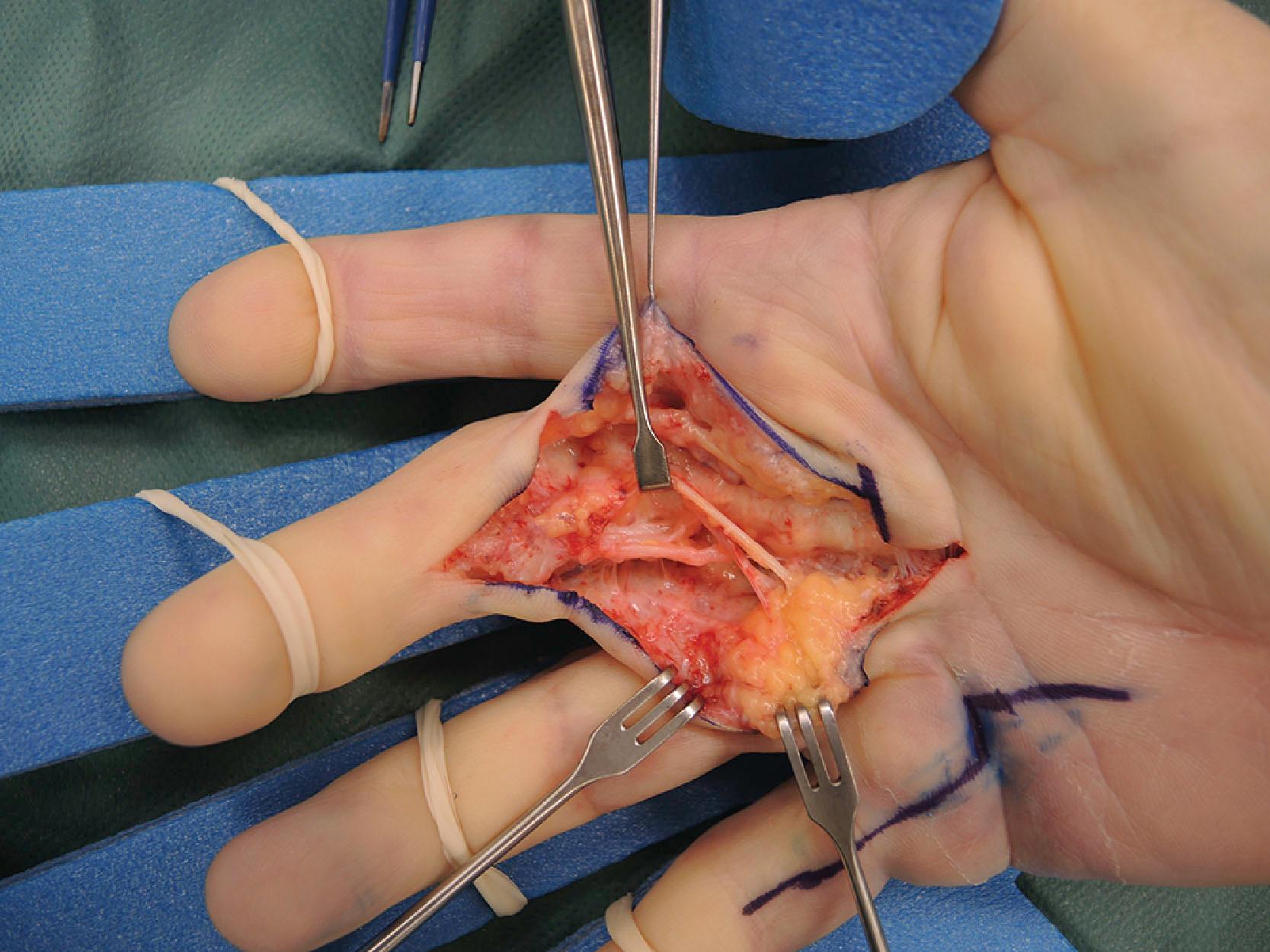 Figure 17.15, On the ulnar side of the middle finger, a cord can be seen that originates from fibers that emerge from deep to the neurovascular bundle at the level of the A1 pulley (PSS intermediate fibers) and which blend with fibers that originate from the A2 pulley (PSS distal fibers) that blend with fibers that originally have been described by Cleland and have been renamed by Zwanenburg et al . into Cleland’s PIP proximal (PIP-P). They have their origin at the PIP joint (see text) and can cause a PIP joint contracture. Since they are located so deeply and carry the neurovascular bundle, they are hard to divide safely during needle fasciotomy. PIP, Proximal interphalangeal; PSS, palmodigital spiraling system.