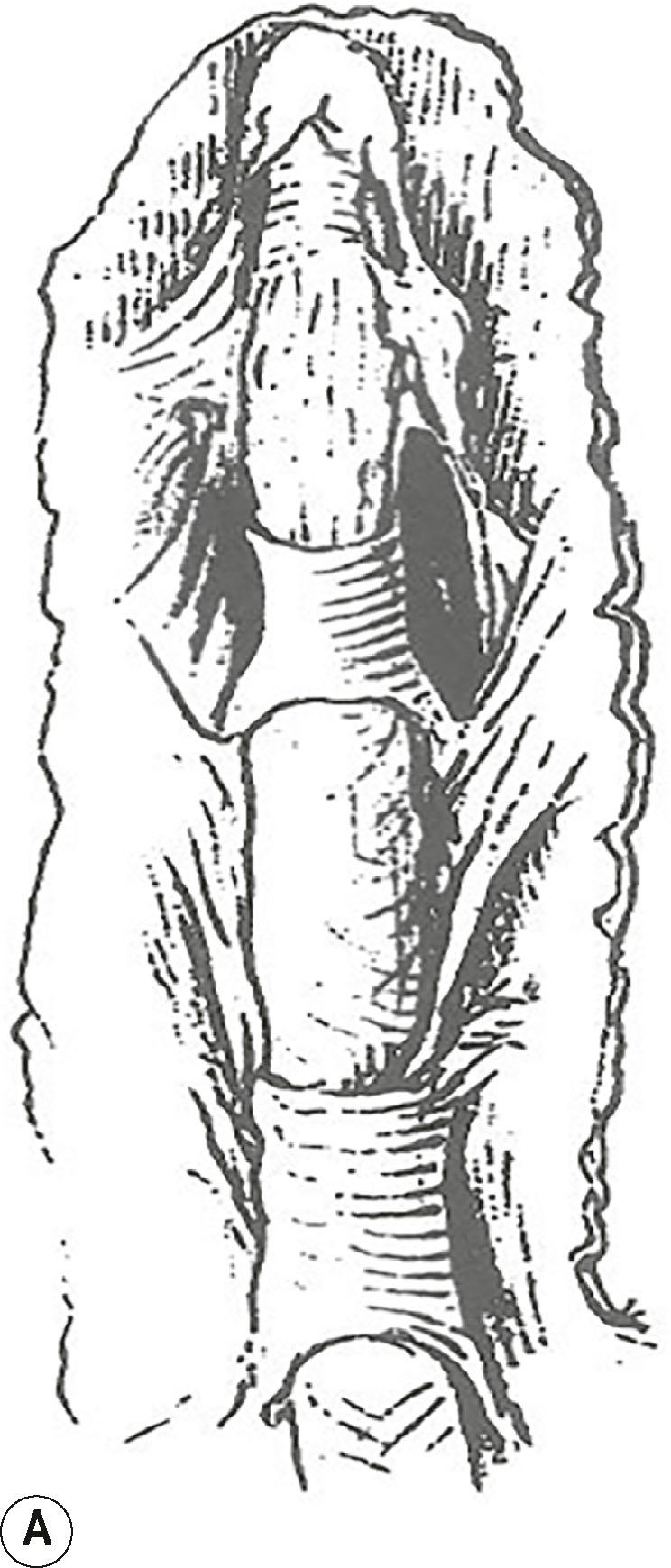 Figure 17.16, Four representations of the digital fasciae. In (B-D) Cleland’s ligaments are depicted on the right and Grayson’s ligaments on the left side of the finger. (A) Cleland’s original drawing (1878). The finger joints are not distinguishable. (B) Grayson’s illustration (1941). (C) Milford’s findings (1968). (D) McFarlane’s drawing (1990), merely based on (C) and the most widely used figure about the orientation of the cutaneous ligaments.