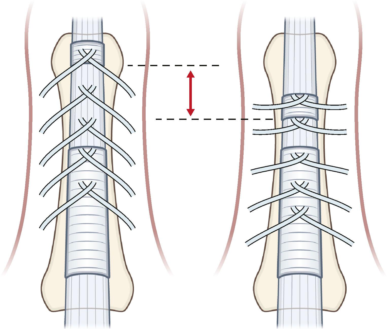 Figure 17.17, The orientation of the most condensed part of a trabecular network of fibers that is located volar to the neurovascular bundle. It consists of fibers that originate from the outside of the flexor tendon sheet and end more proximally on the contralateral side of the finger, causing an inverted V-shaped orientation, which becomes less pointed during flexion.