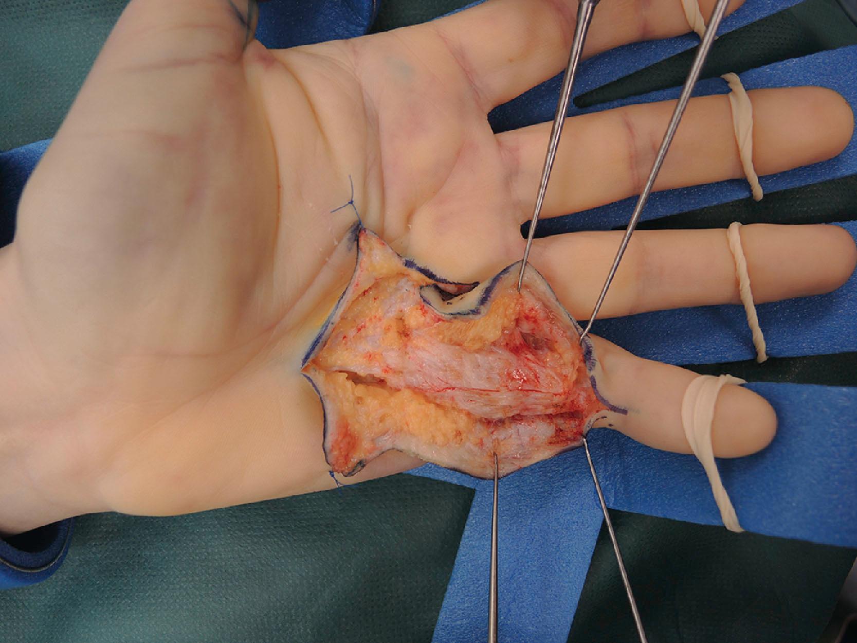 Figure 17.19, Layer 1 cord continuing into central cord formed by fibers of Grayson’s trabecular network. At the proximal interphalangeal level they bifurcate and end on the side of A4. Note that the normal inverted V fibers as a result of contracture at the level of the proximal phalanx have realigned to form a non-inverted V shape.