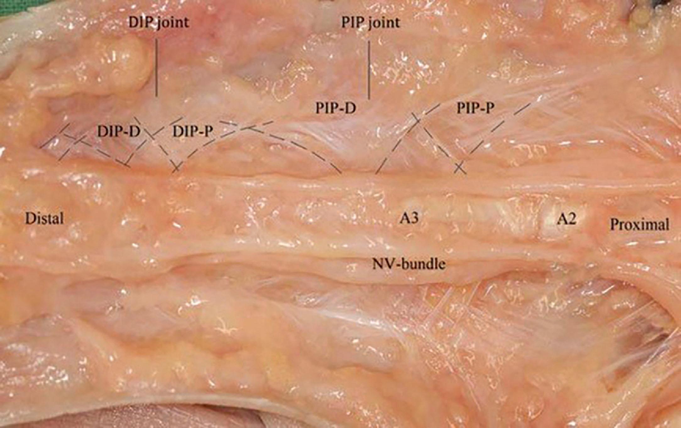 Figure 17.20, Showing the orientation of Cleland’s ligaments, PIP distal and PIP proximal (PIP-D and PIP-P), originating mainly from the proximal phalanx, and the DIP distal and DIP proximal (DIP-D and DIP-P) ligaments, arising from the distal part of the middle phalanx. DIP, Distal interphalangeal; NV, neurovascular; PIP, proximal interphalangeal.