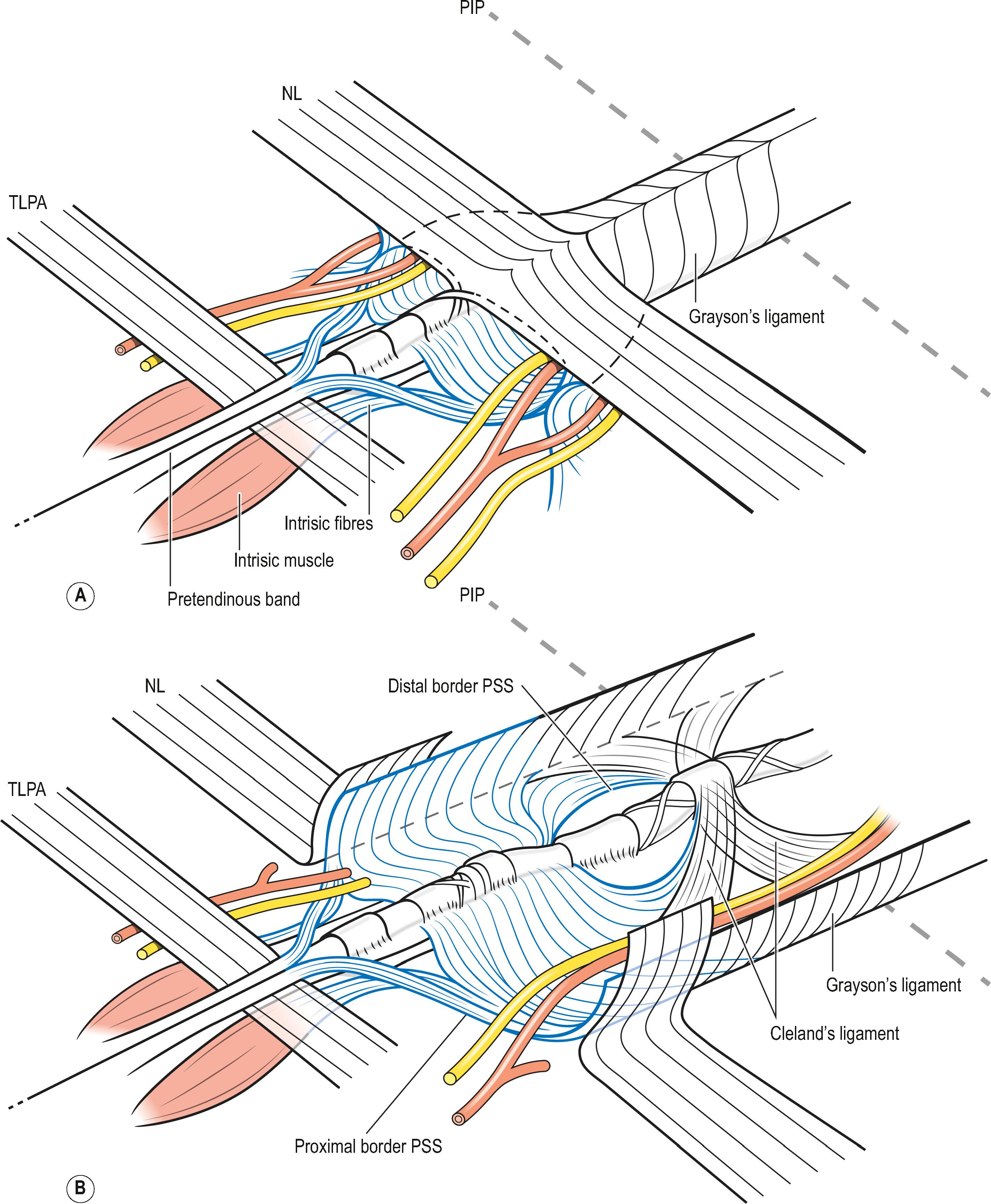 Figure 17.21, (A) Schematic drawing of the microanatomy of the palmodigital junction with the PSS as it would be in the undissected state. On both sides the neurovascular bundles have been visualized as they enter the neurovascular tunnel in relation to PSS, which is marked in blue. Layers 1 and 3 of the pretendinous fibers (see Figs. 17.8 & 17.10 ) have been omitted for clarity. (B) Schematic drawing of PSS after NL has been released from the flexor tendon sheath, opened in the midline, and reflected bilaterally. Note the layer 2 fibers blending with the fibers from the intrinsic muscle fascia, with in between a triangularly shaped space to form the proximal border of PSS. The natatory ligament (NL) covers the PSS and takes up fibers from it. The original attachment of NL on the A1 pulley has been left as an orientation point. Figure 17.21 cont’d (C) Schematic drawing of the pathologically changed (shortened and straightened) layer 2 of the pretendinous fibers that forms the palmar spiral cord, which – due to its attachment on the undersurface of the NL – dictates the place where a palmar spiral nerve is always located, and where it is most vulnerable during surgery of the palm. Please refer to Fig. 17.11 for a clinical example of a palmar spiral cord. Note that Grayson’s trabecular network is also pathologically changed on the right side of the finger in this illustration. NL, Natatory ligament; PIP, proximal interphalangeal; PSS, palmodigital spiralling system; TLPA, transverse ligament of the palmar aponeurosis.