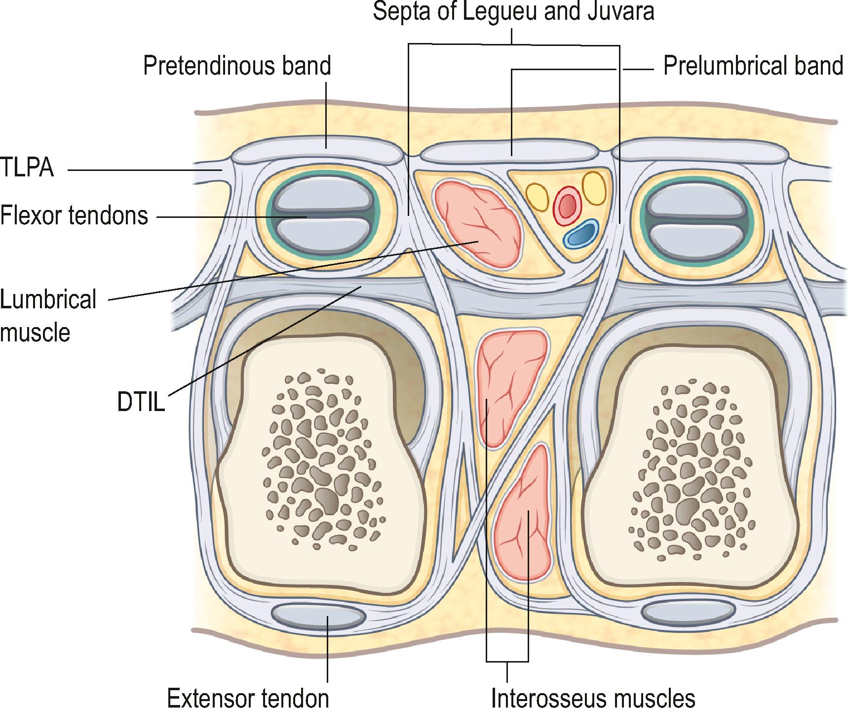 Figure 17.3, Cross section of the hand at the level of the heads of the metacarpal bones. Shown are: pretendinous band; transverse ligament of the palmar aponeurosis (TLPA); prelumbrical bands; septa of Legueu and Juvara, penetrating the deep transverse intermetacarpal ligament of the palm and reaching the dorsal aspect of the hand; interosseus muscles; flexor tendons; extensor tendon. DTIL, Deep transverse intermetacarpal ligament; TLPA, transverse ligament of the palmar aponeurosis.