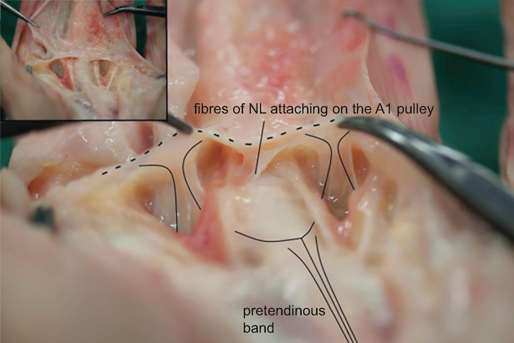 Figure 17.4, Anatomical dissection showing the attachments of natatory ligament (NL) on the A1 pulley, and the blending of layer 2 fibers of the pretendinous bands of adjacent fingers (that form the proximal edge of the palmodigital spiraling system) just before its insertion on the dorsal surface on NL.