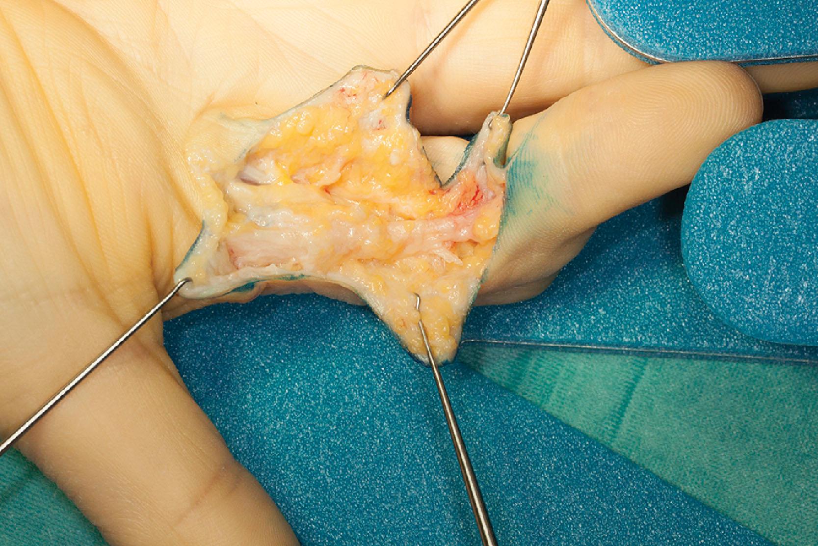 Figure 17.5, Distal commissural cord continuous with lateral digital sheet cord, Grayson’s cord, and ending on A4 pulley, causing a first web contracture and a proximal interphalangeal joint joint contracture of the index finger. Natatory ligament not shown.