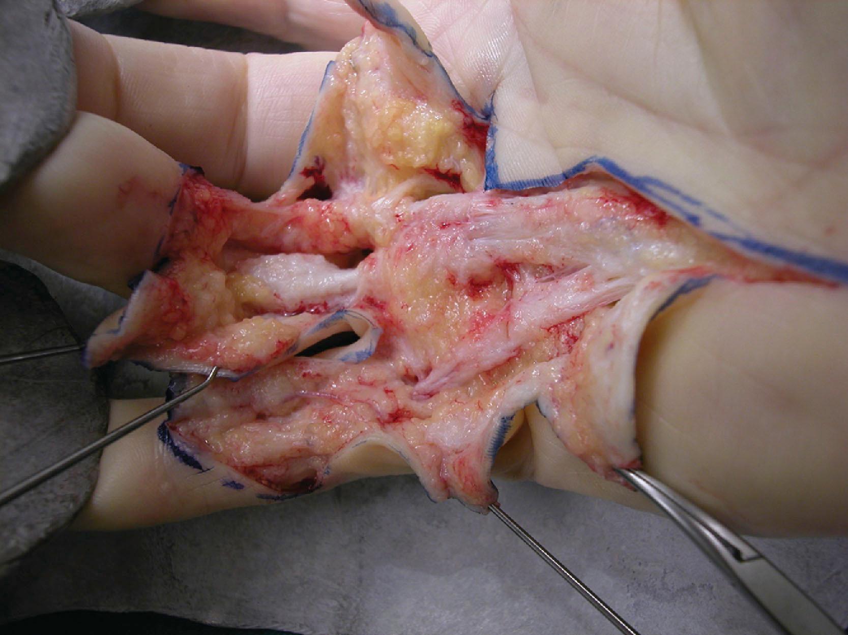 Figure 17.9, Early stage of dissection for limited fasciectomy in case with contractures of the ring and little fingers of the right hand. In the little finger a pretendinous (PT) cord continuing as layer 1 cord is visible, that forms a central cord in the proximal phalanx together with pathology developing in Grayson’s trabecular network of the proximal phalanx. On the radial side of the cord just proximal of the fat pad, the transverse ligament of the palmar aponeurosis can be distinguished. Distal to the fat, natatory ligament (NL) can be seen. In the ring finger a PT cord that divides into a layer 1 and a layer 2 cord on the radial side of it can be distinguished, also showing a spiral nerve just proximal of NL. Note that the skin has been elevated off the spiral nerve together with the fat pad.