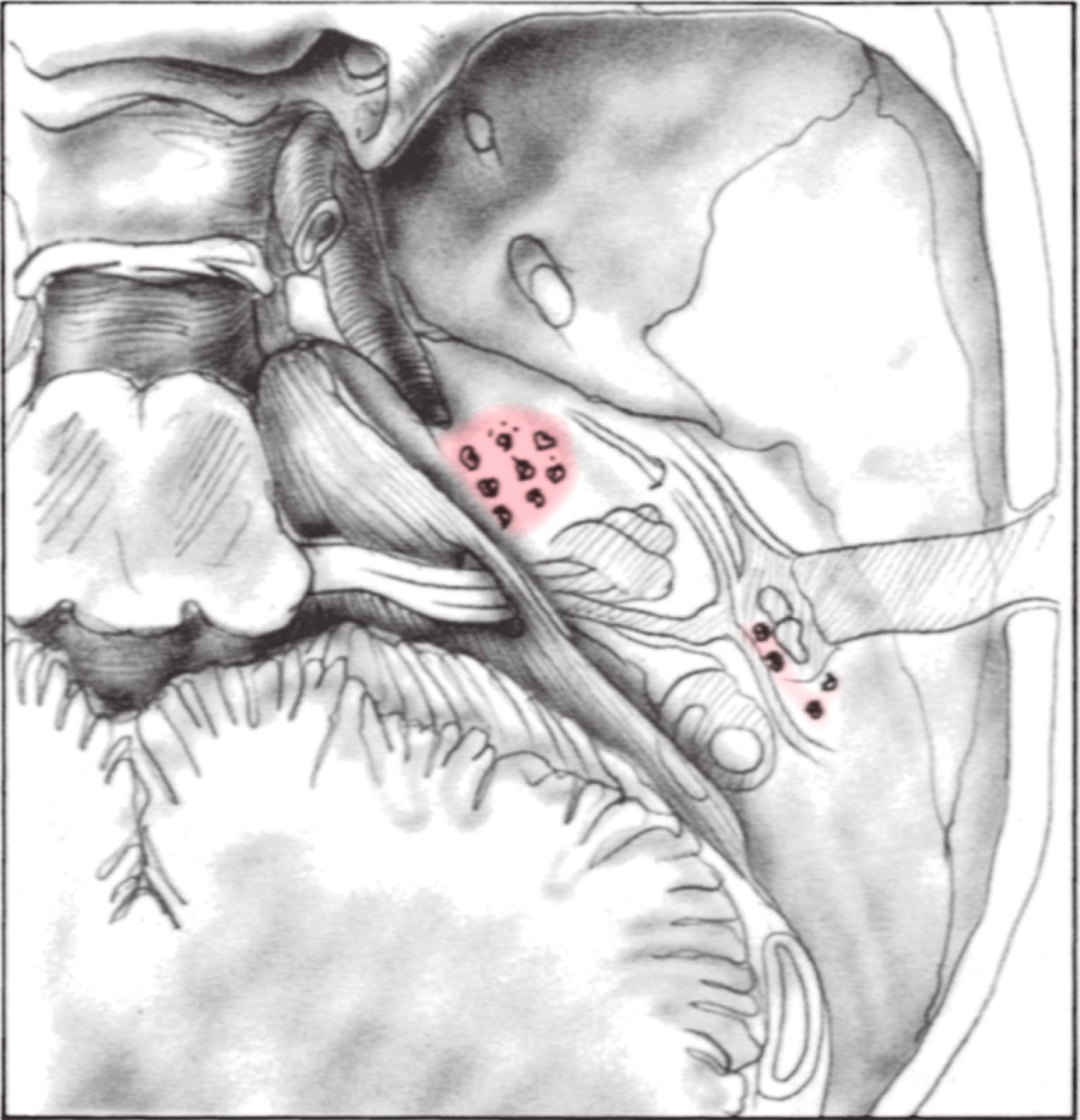 Fig. 21.3, View of the middle cranial fossa floor showing the frequent sites of bony defects.