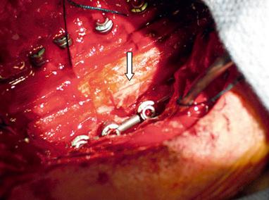 FIGURE 53-2, Intraoperative photograph demonstrating a primary dural repair augmented with bovine pericardium ( arrow ).