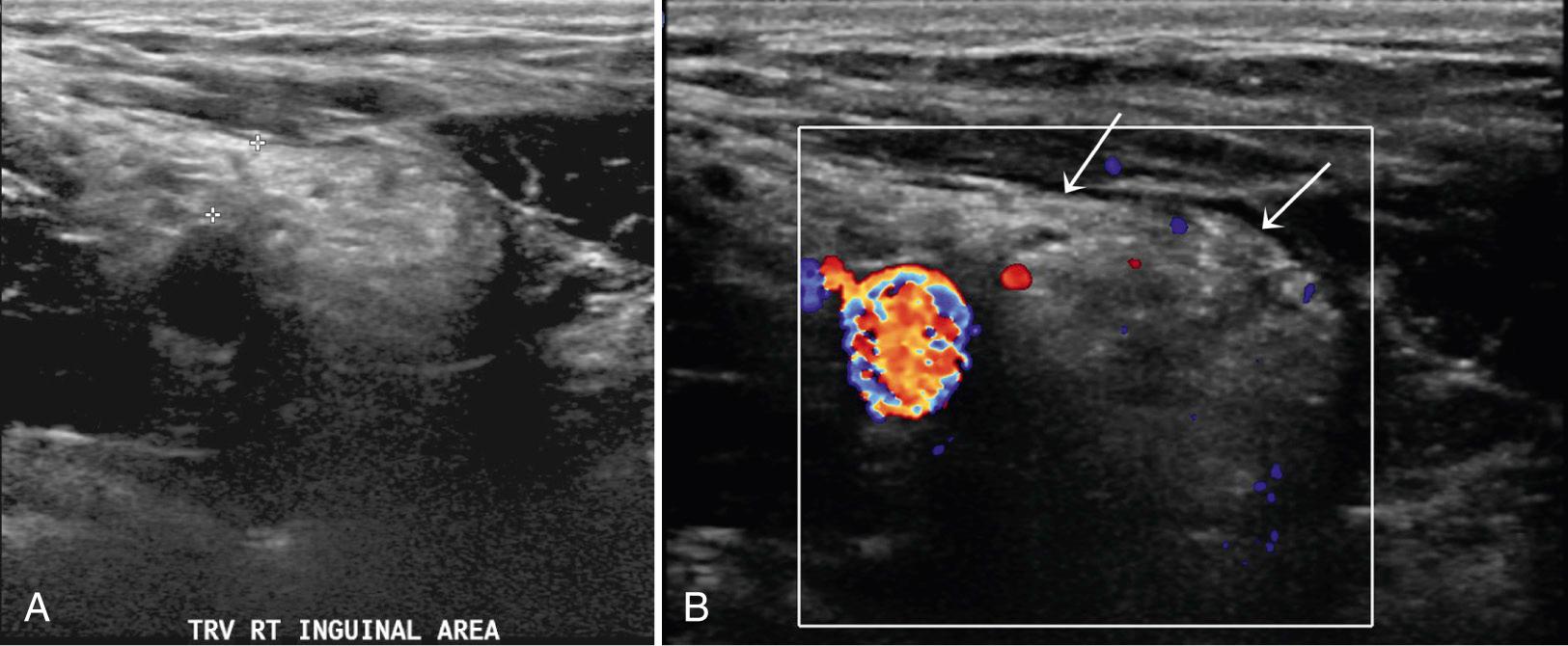 FIG. 13.3, Indirect Inguinal Hernia.