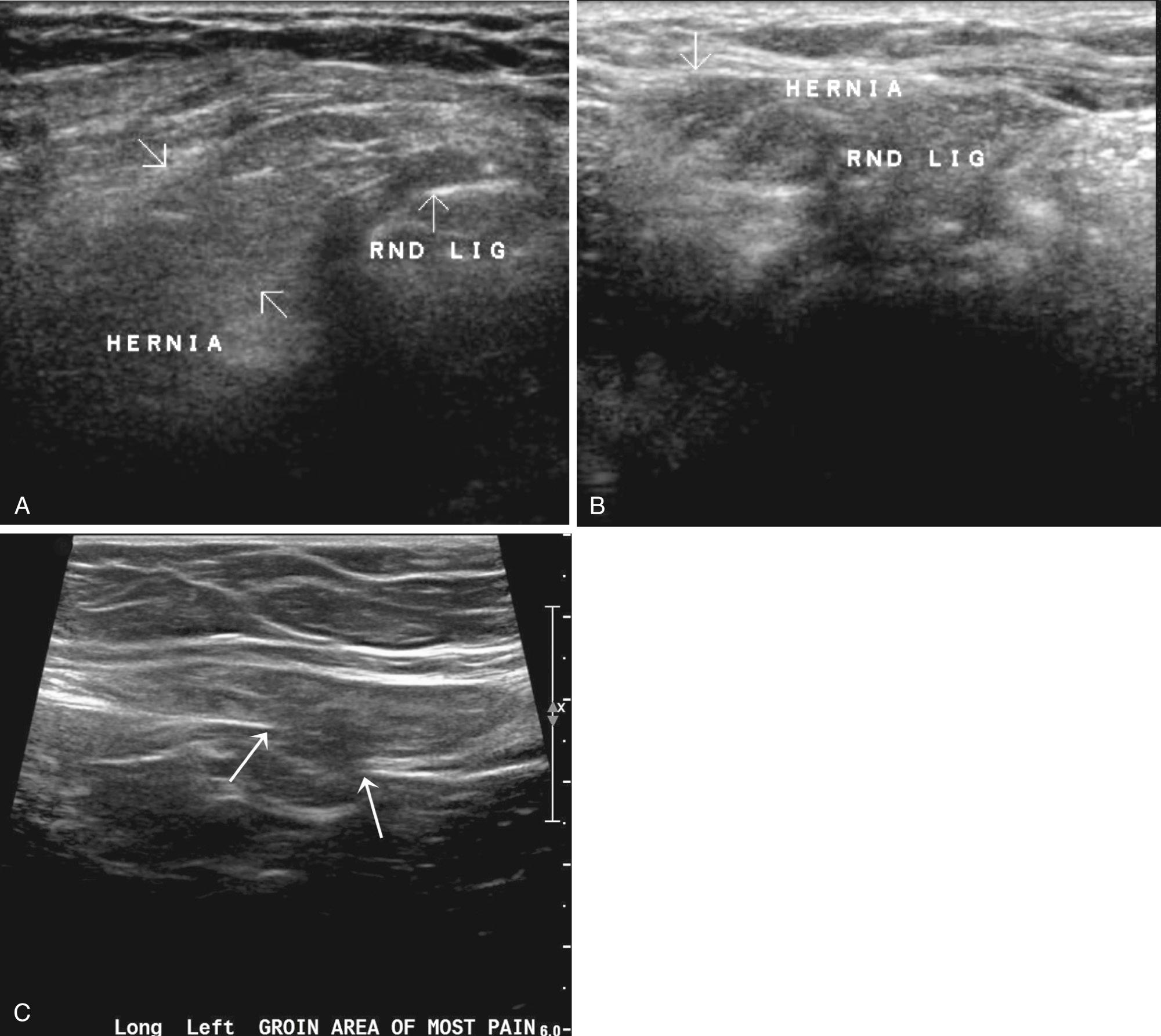 FIG. 13.15, Indirect Inguinal Hernia.