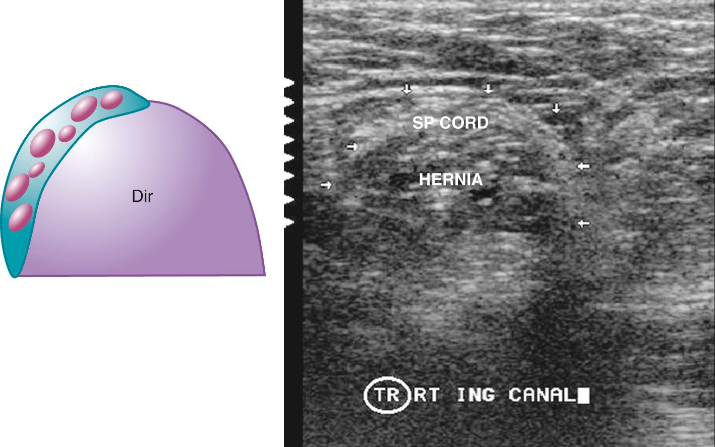 FIG. 13.17, Direct (Dir) Inguinal Hernia.