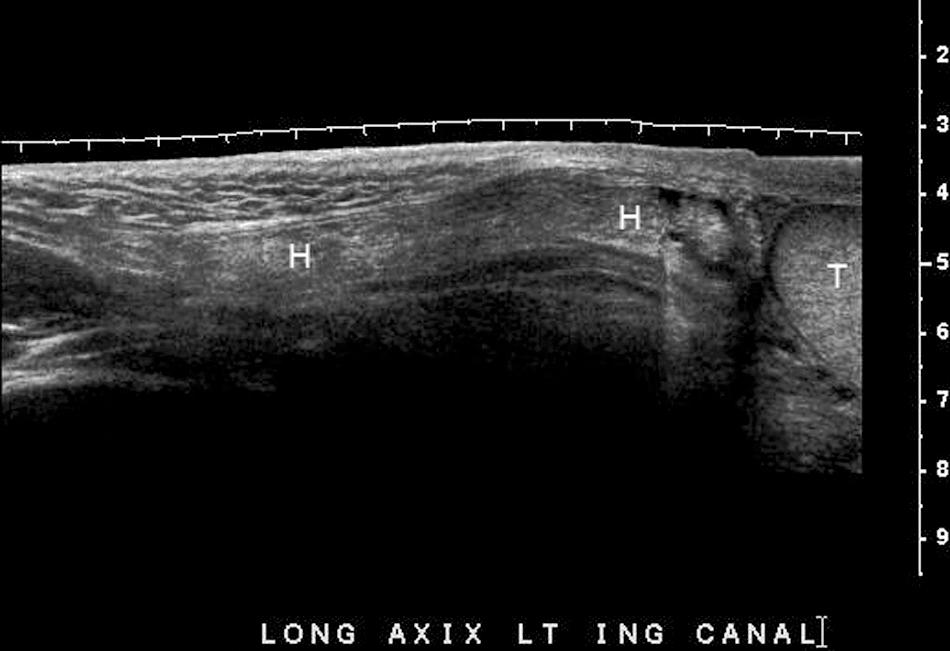 FIG. 13.18, Indirect Inguinal Hernia.