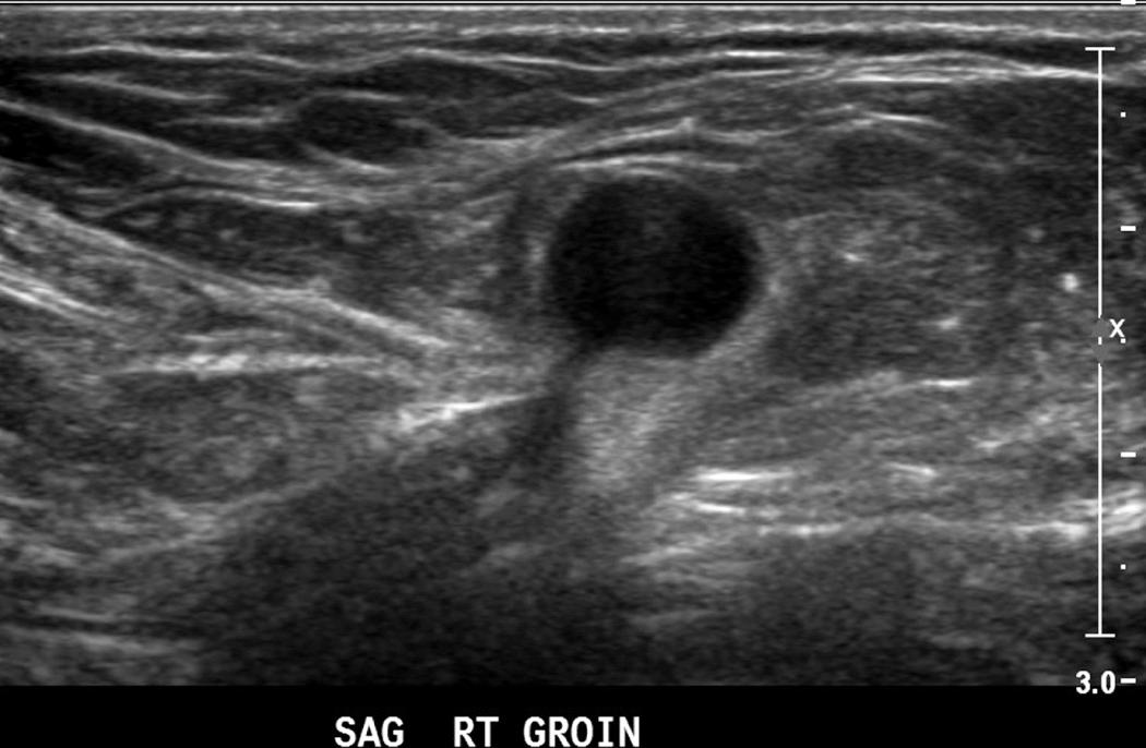 FIG. 13.4, Fluid-Containing Incarcerated Direct Inguinal Hernia.