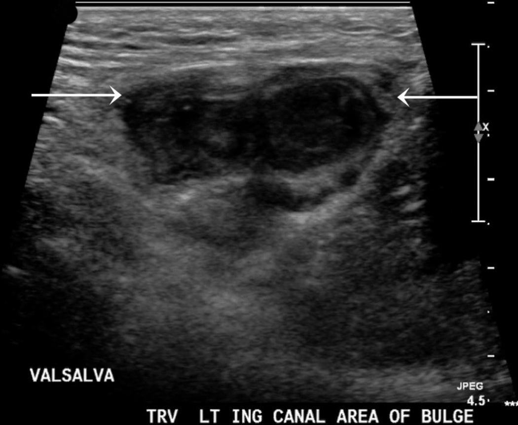 FIG. 13.5, Bowel-Containing Inguinal Hernia.