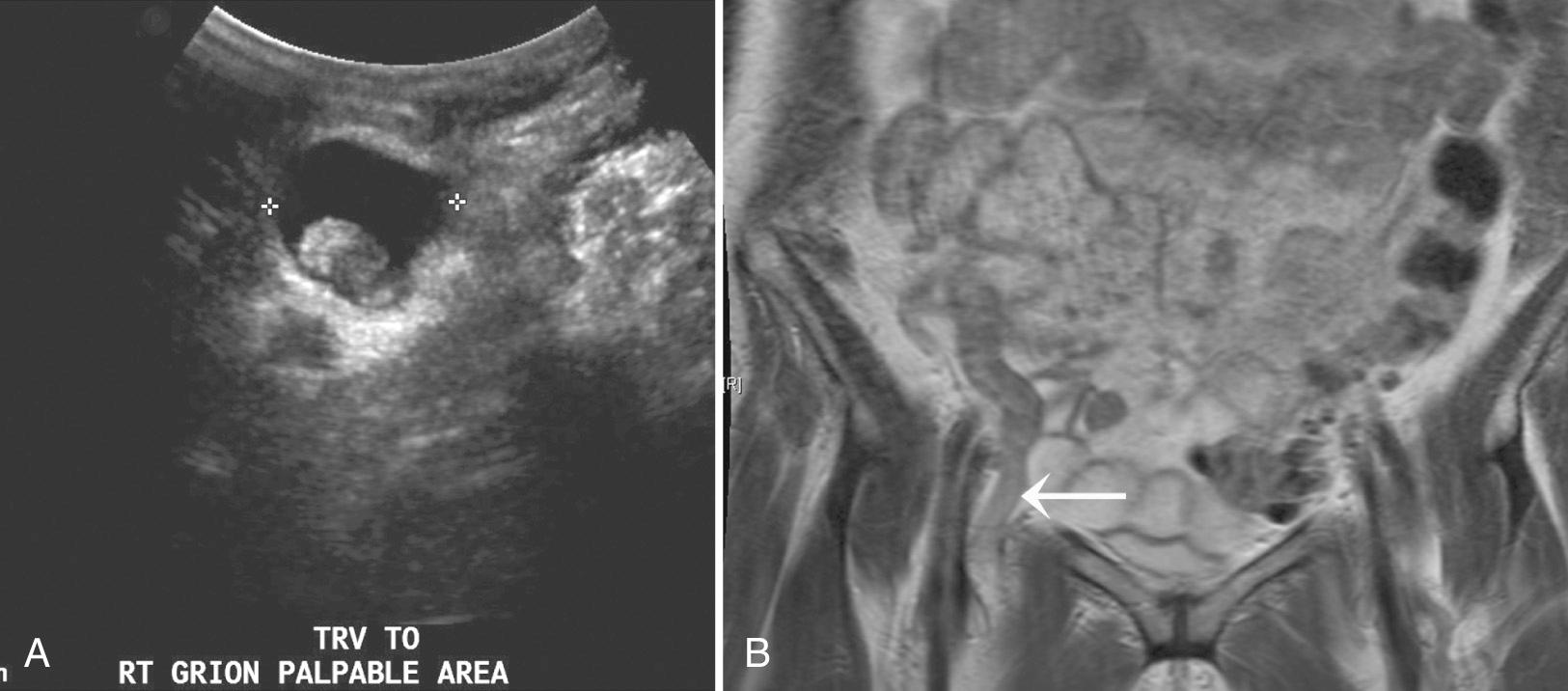 FIG. 13.6, Amyand Hernia.