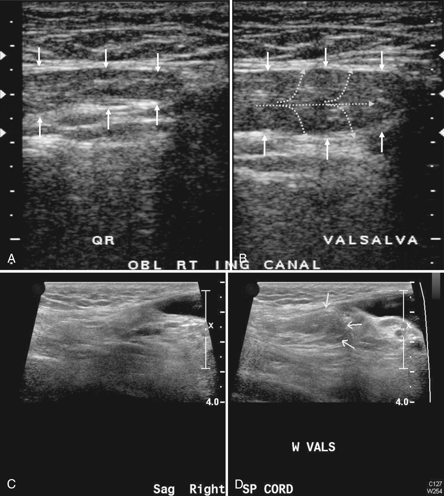 FIG. 13.7, Value of Valsalva Maneuver. Indirect Inguinal Hernias.