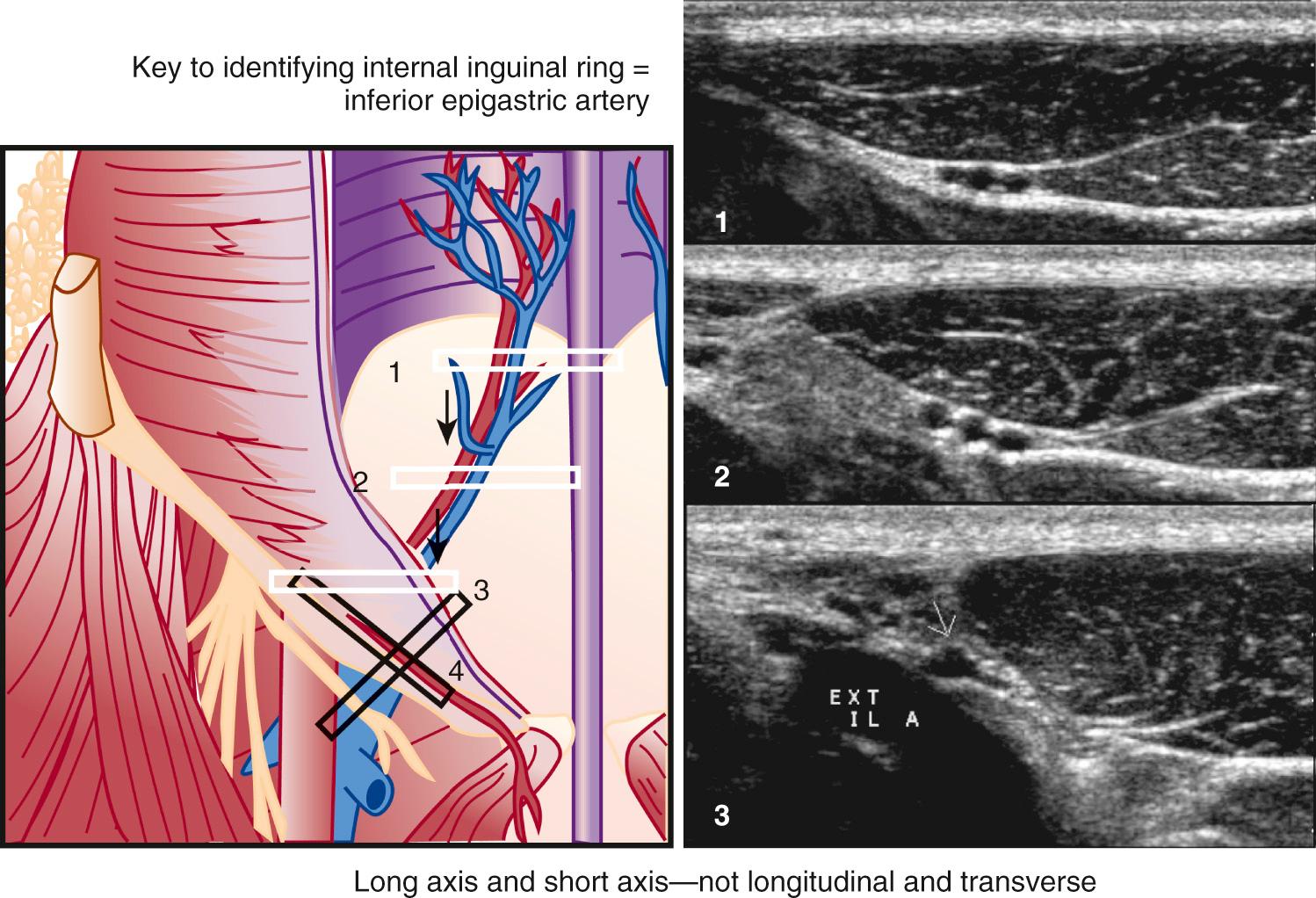 FIG. 13.9, Inferior Epigastric Vessels (IEVs) Are Main Landmarks for Evaluating Inguinal Area.