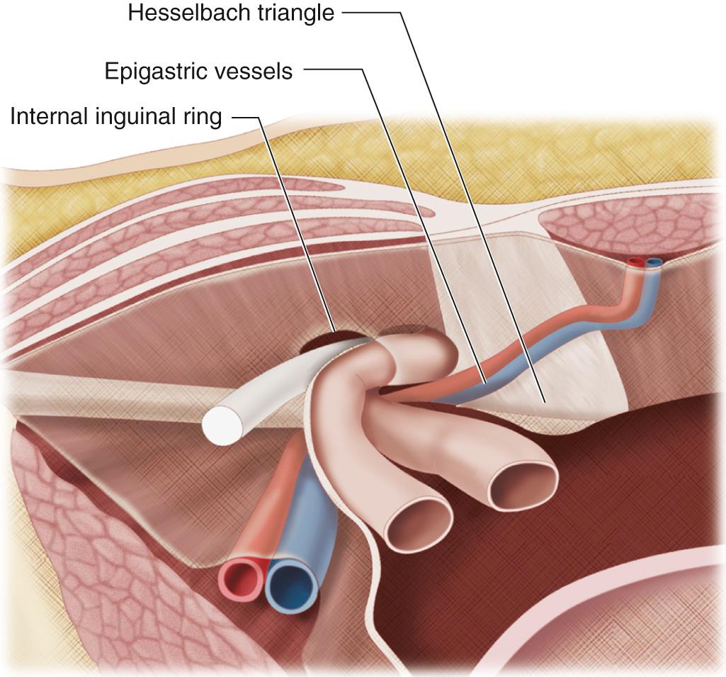 FIG. 13.11, Indirect Inguinal Hernia.