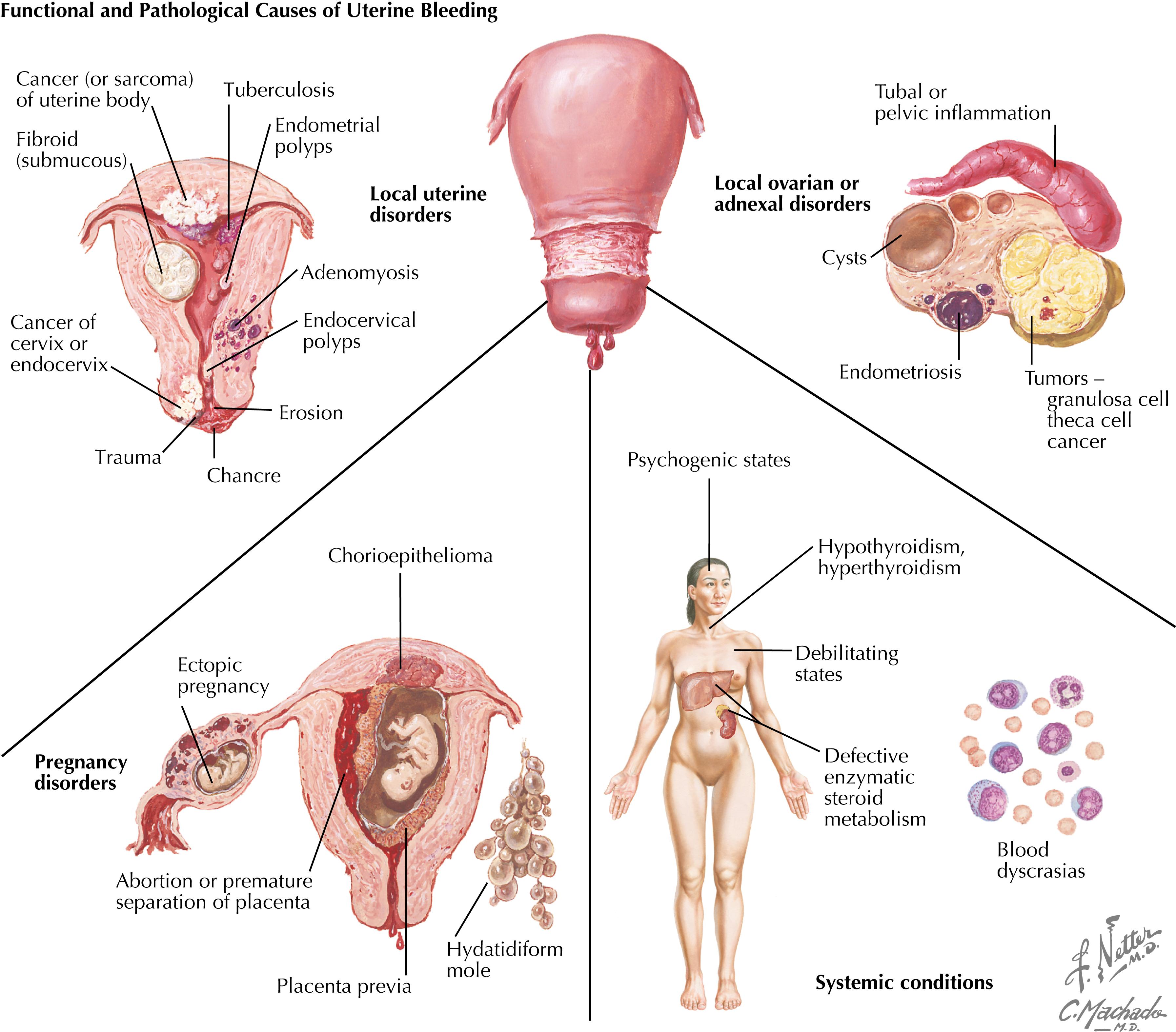 Figure 132.2, Functional and pathologic causes of uterine bleeding