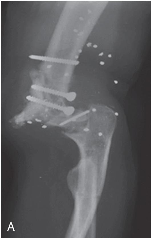 FIG 97.1, Gross instability is seen after posttraumatic conditions (A) and established nonunion (B) and is caused by inflammatory arthritis such as an arthritis mutilans expression of rheumatoid arthritis (C).