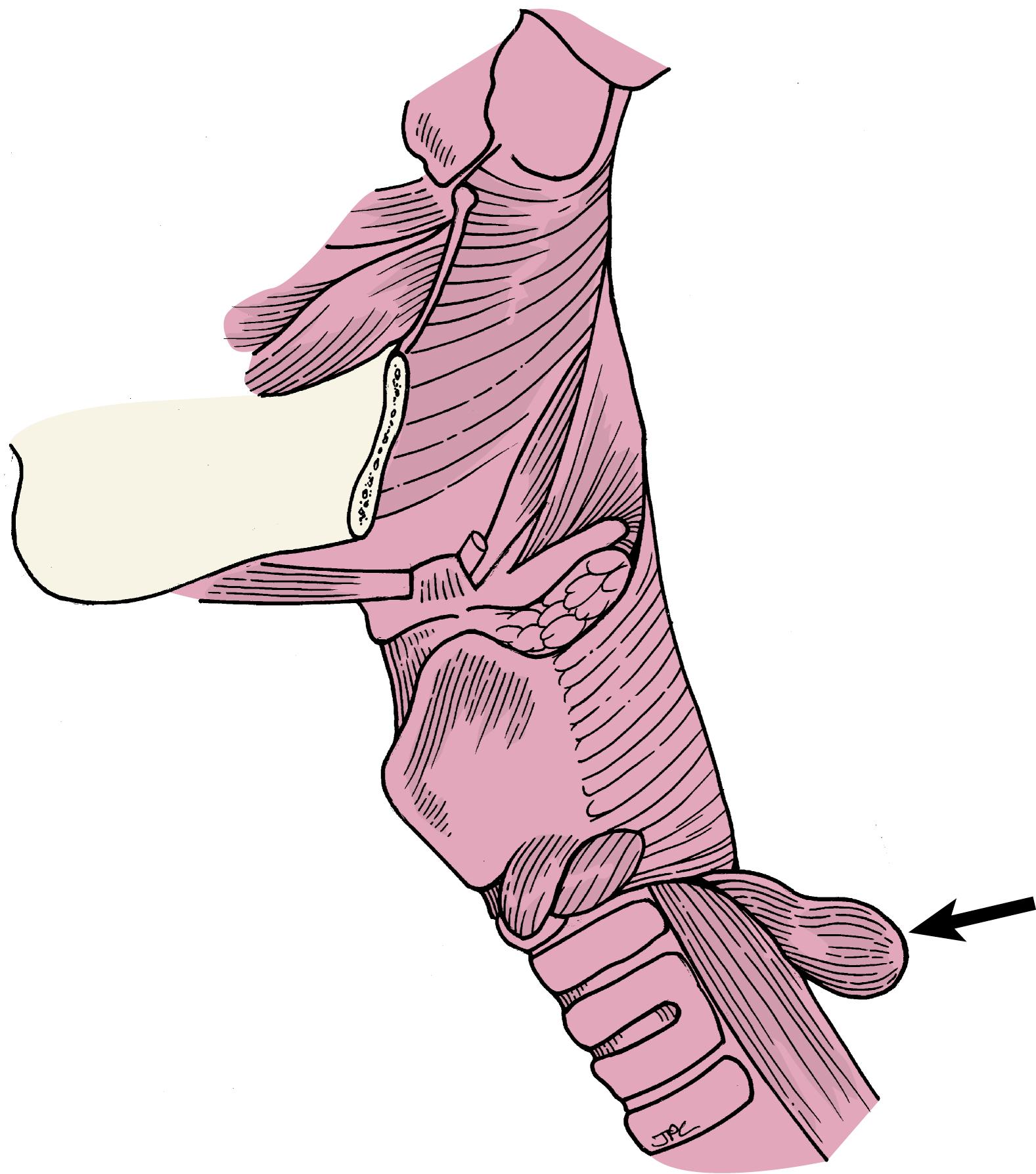 Fig. 46.1, Zenker’s diverticulum posterior to the esophagus (arrow).